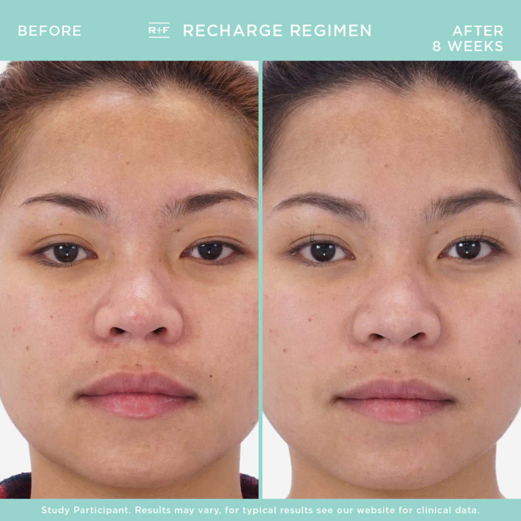 Recharge Young Skin before and after