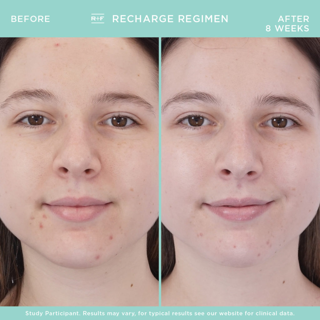 Recharge Young Skin before and after