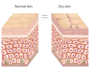 Normal vs dry skin illustration
